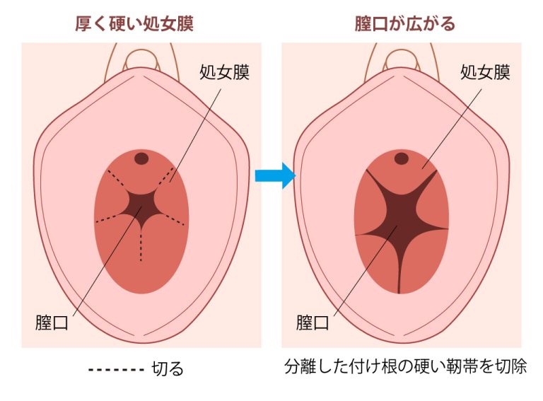 処女膜強靭症