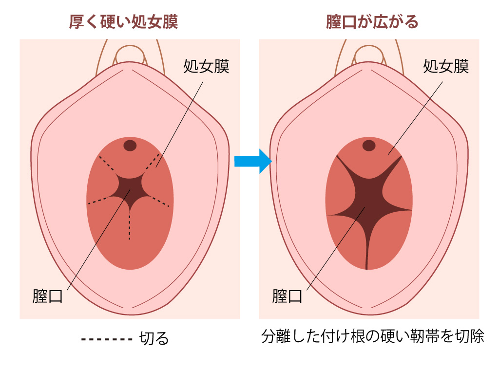 処女膜切開